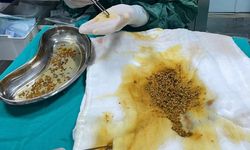 Bingöl'de dikkat çeken durum: Safra kesesinden 2 bin 67 taş alındı