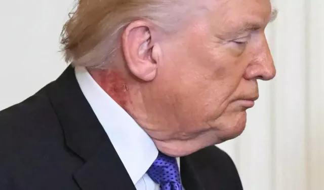 Trump Sıkıntıdan Kurdeşen mi Döküyor?