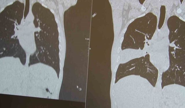 İstanbul'da hastanın akciğerinden kemik çıktı: 'Kemiği seven biriyim, şaşırtmadı'