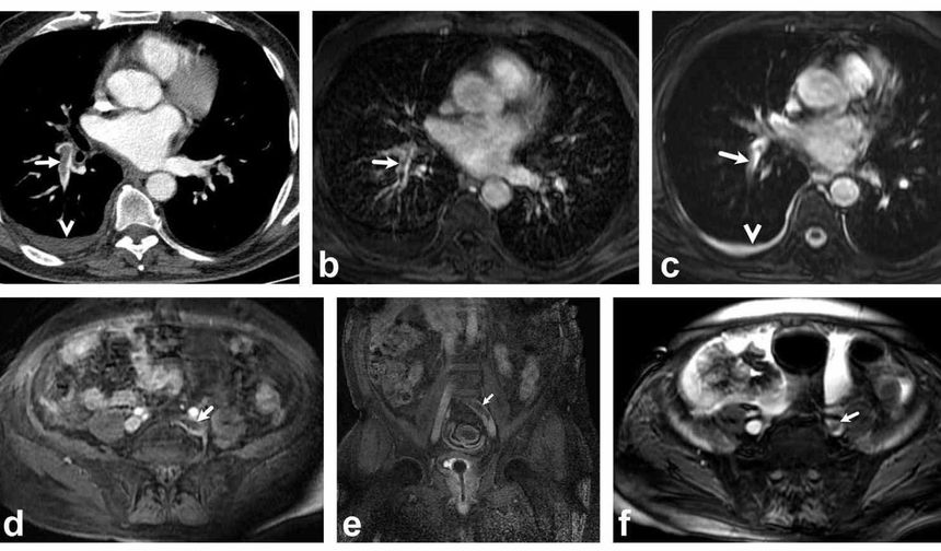 Akciğer damarındaki pıhtıların tanısında radyasyonsuz çözüm