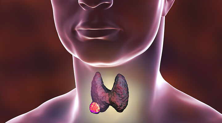Tiroid Nodul Nedir